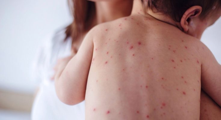 Η Διεύθυνση Δημόσιας Υγείας της Περιφέρειας ενημερώνει για την ιλαρά