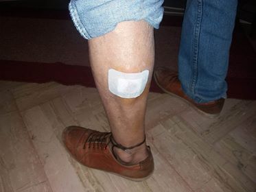 Στο κέντρο υγείας ηλικιωμένος από δάγκωμα σκύλου στη Βόνιτσα (δείτε φωτο)