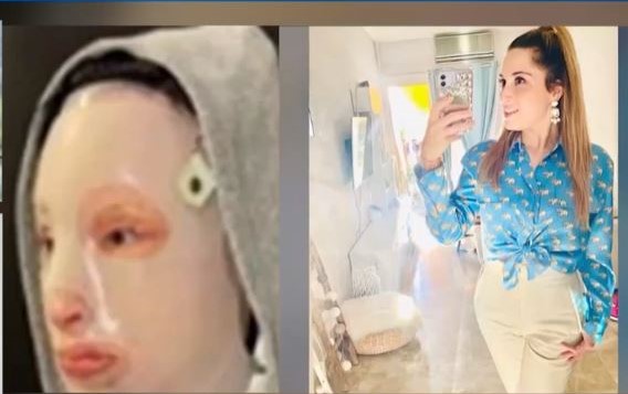 Επίθεση με βιτριόλι: Η Ιωάννα ζει σε ιδιότυπη φυλακή – Δεν μπορεί να βγει στον ήλιο