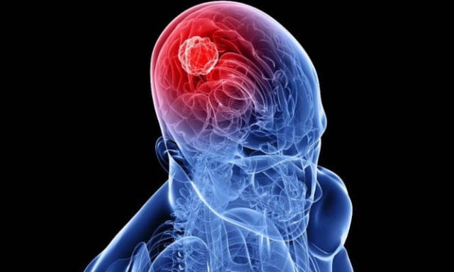 Εμβόλια mRNA: Ελπίδες για λύση και στους επιθετικούς όγκους εγκεφάλου