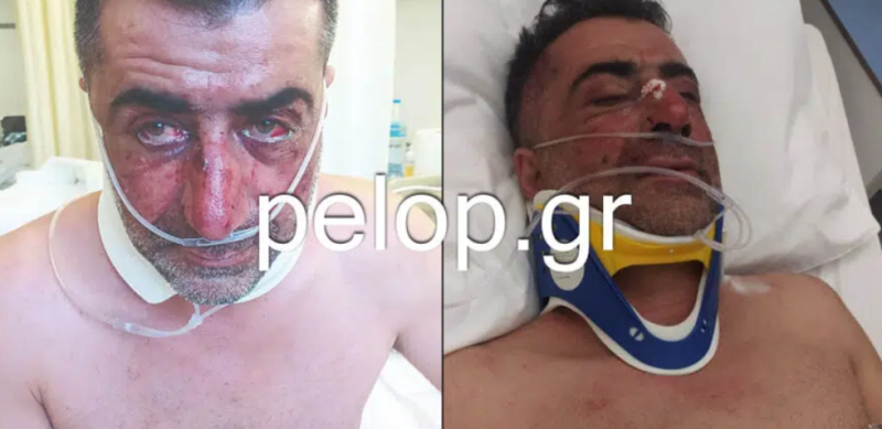 Άγριος ξυλοδαρμός Λαλιώτη: Σοκάρουν οι εικόνες από τα τραύματα του πρώην περιφερειακού συμβούλου Δυτικής Ελλάδας