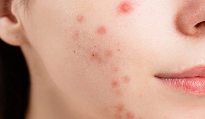 Πάτρα: 16χρονη διαγνώστηκε με σύφιλη – Νοσηλεύεται σε απομόνωση