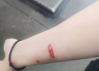 Αγρίνιο/ Αδέσποτο σκυλί επιτέθηκε σε 60χρονη & 25χρονη και την τραυμάτισε!