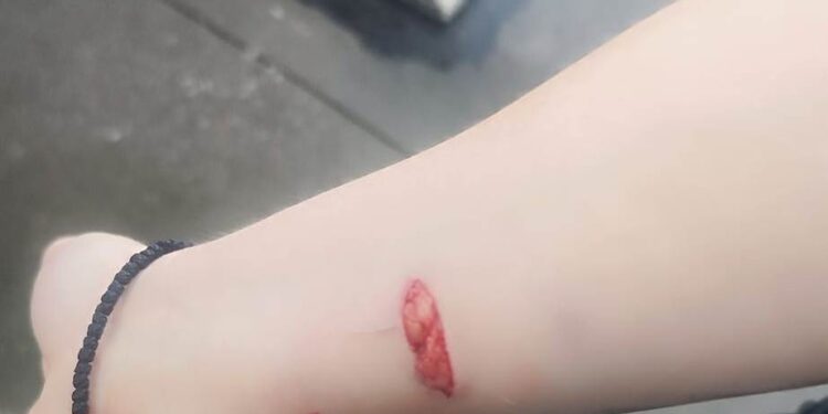 Αγρίνιο/ Αδέσποτο σκυλί επιτέθηκε σε 60χρονη & 25χρονη και την τραυμάτισε!