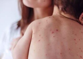 Iλαρά: Η πιο μολυσματική ασθένεια που έχει γνωρίσει η επιστήμη – Η σημασία του εμβολιασμού