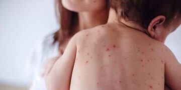 Iλαρά: Η πιο μολυσματική ασθένεια που έχει γνωρίσει η επιστήμη – Η σημασία του εμβολιασμού
