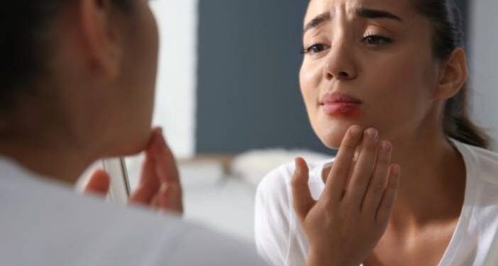 Επιχείλιος έρπης: Ο ύπουλος και εξαιρετικά μεταδοτικός ιός