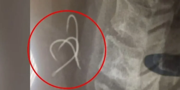 Αγρίνιο: Η απίστευτη ψυχραιμία που έδειξε ο 38χρονος που έφαγε το χταπόδι με 3 αγκίστρια – «Μου κόπηκε η ανάσα»