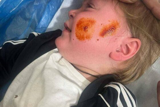 Αιτωλικό: Οργή για τον τραυματισμό παιδιών από αδέσποτο