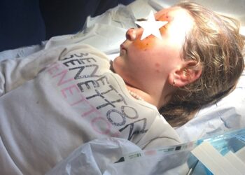 Σοκ στα Καλύβια Αγρινίου: Κινδύνεψε η ζωή παιδιού 4,5 ετών από άγρια επίθεση σκύλου