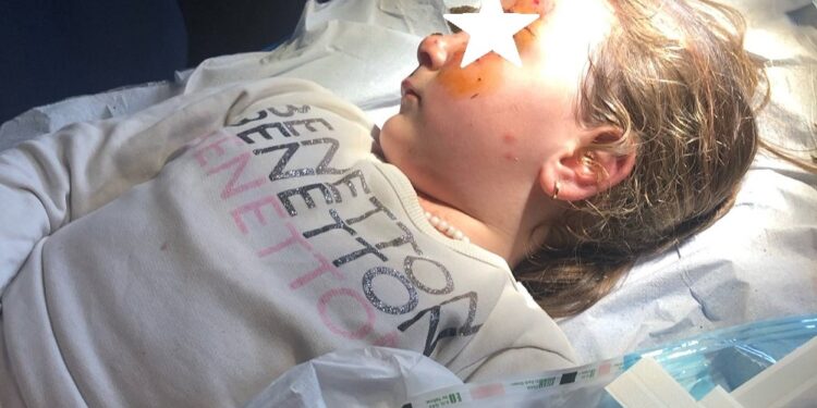 Σοκ στα Καλύβια Αγρινίου: Κινδύνεψε η ζωή παιδιού 4,5 ετών από άγρια επίθεση σκύλου