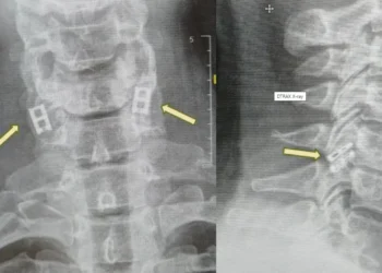 Μεταμόσχευση νωτιαίου μυελού με κύτταρα από τον ίδιο τον ασθενή για πρώτη φορά παγκοσμίως στο Ισραήλ. Επανάσταση στην αναγεννητική ιατρική!