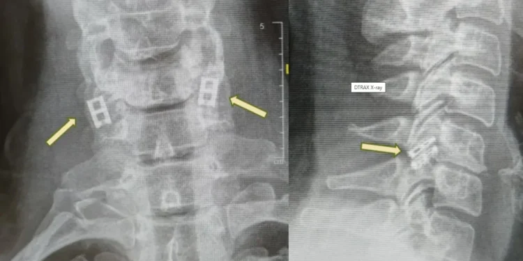 Μεταμόσχευση νωτιαίου μυελού με κύτταρα από τον ίδιο τον ασθενή για πρώτη φορά παγκοσμίως στο Ισραήλ. Επανάσταση στην αναγεννητική ιατρική!