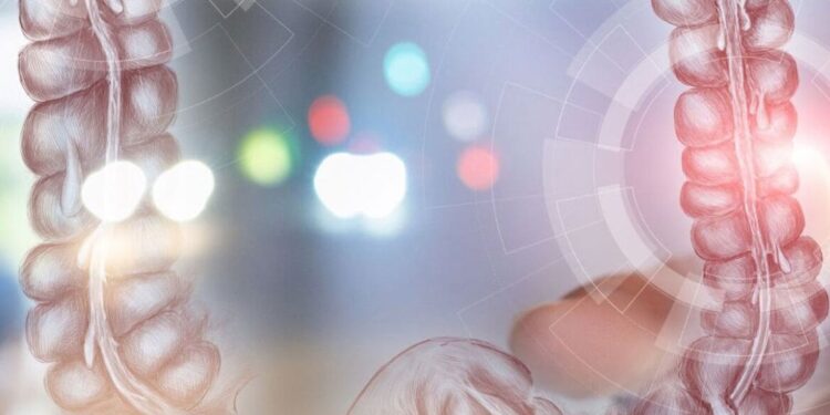 Εκκολπωμάτωση παχέος εντέρου: Παράγοντες κινδύνου και θεραπεία