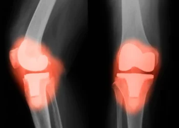 Ρομποτική υποβοήθηση στην ολική αρθροπλαστική γόνατος: Τα πλεονεκτήματα της μεθόδου