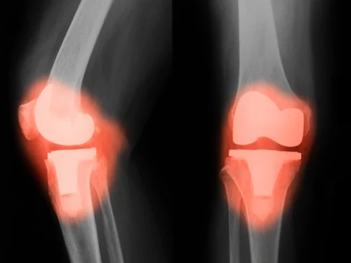 Ρομποτική υποβοήθηση στην ολική αρθροπλαστική γόνατος: Τα πλεονεκτήματα της μεθόδου